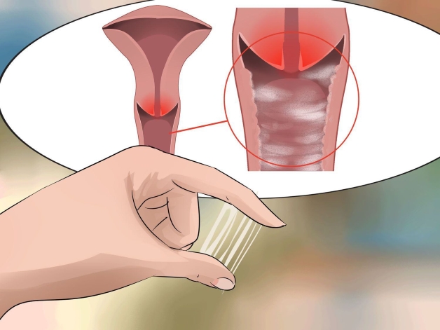 Nữ giới viêm nhiễm vùng kín có nguy cơ mắc vô sinh thứ phát